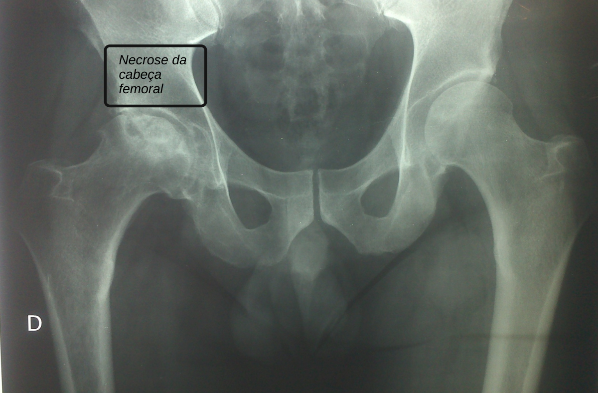 Osteonecrose Da Cabeça Femoral – Dr. Márcio Pozzi